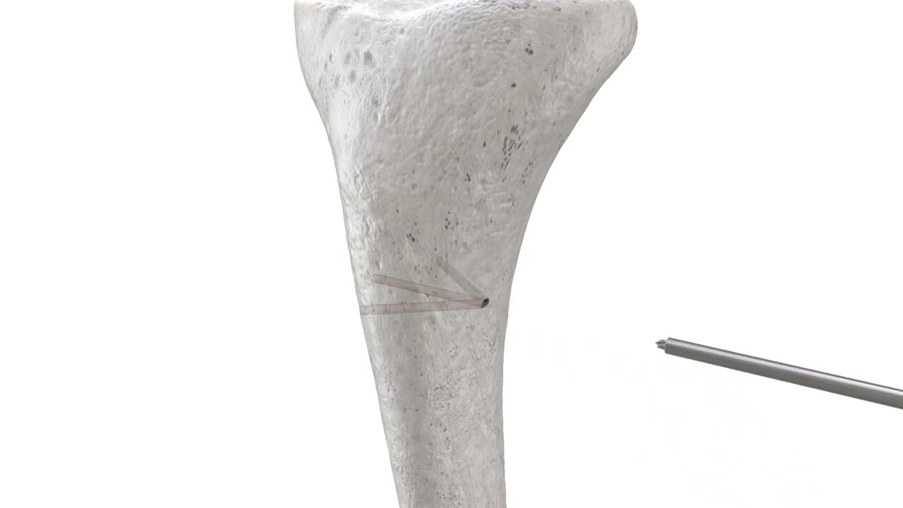 PRECICE Plate Assisted Bone Segment Transport - YouTube