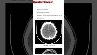 #mbbs #radiology ring enhance lesions