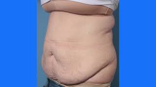 Removing loose skin with a tummy tuck!