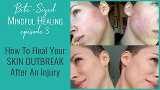 How To Heal Your Skin Outbreak After An Injury - Bite-Sized Mindful Healing #3