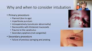 Lecture: Lacrimal Duct Obstruction in Children