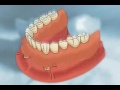 different types of dentures