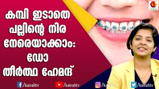 പല്ലിലെ കമ്പിയുടെ അഭംഗി ഒഴിവാക്കാൻ അലൈനേഴ്സ് | Dr Theertha Hemant | smile designing