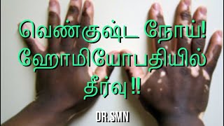 வெண்குஷ்டம் எதனால் வருகிறது ?? Vitiligo ஹோமியோபதி  மூலம் வெண்குஷ்ட நோயை சரி செய்யலாம் !!#vitiligo