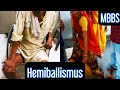 Hemiballismus- Lesion of Subthalamic Nucleus of Basal Ganglia #mbbs #neet #next