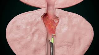 The Best Treatment for Enlarged Prostate: Prostate Artery Embolization