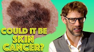 The ABCDE Skin Check for Malignant Melanoma - My story of a Scary Looking Mole! - Dr Gill