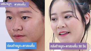 รีวิวจมูก+ตาสองชั้น 30 วัน  มาทำก่อนที่จะก้าวเข้าไปสู่รั้วมหาลัย ที่ธีรพรคลินิก หมอชลธิศ