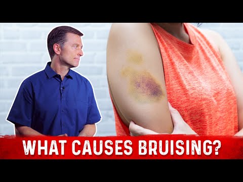 What Causes Bruising (without trauma)? What Causes Bruising (without trauma)?