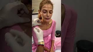 Botox treatment at transform clinic  #shorts #shortsvideo #youtubeshorts #khushi
