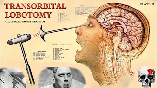 The TERRIFIC History of Lobotomy