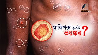 মাঙ্কিপক্স কতটা ভয়ঙ্কর? | Monkeypox virus | Maasranga News