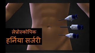 लैप्रोस्कोपिक अम्बिलिकल हर्निया सर्जरी Best Laparoscopic Incisional or Umbilical Hernia  In India