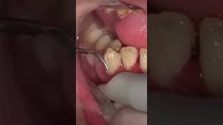 【切り抜き】当院史上最強！の歯石取り🦷✨Very heavy tartar removal This patient was Dental treatment phobia