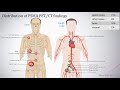 ProPSMA Randomised Study of Ga-68 PSMA PET/CT at EAU 2020