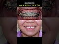 braces for gapped teeth. 32 months duration braces orthodontist dentist