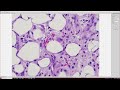 post traumatic fat necrosis encapsulated subcutaneous fat necrosis pathology dermpath dermatology