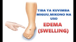 TIBA YA KUVIMBA MIGUU, MIKONO NA USO | EDEMA (SWELLING)