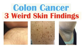 3 Weird Signs of Colon Cancer (Found on the Skin)