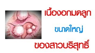 พบหมอเสรี ตอนที่ 428 : เนื้องอกมดลูก ขนาดใหญ่ของสาวบริสุทธิ์