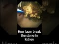 How the Laser Break Kidney stone | Laser Lithotripsy