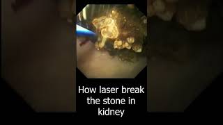 How the Laser Break Kidney stone | Laser Lithotripsy