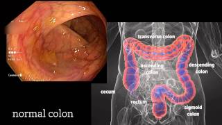 Colonoscopy: A Journey Though the Colon and Removal of Polyps