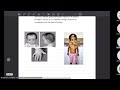 MRCPCH (short stature) Clinical Exam Revision Series 19