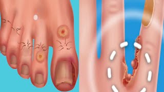 ASMR 시원함 주의! 리얼한 내성 발톱 케어 애니메이션 | Ingrown Toenail removal treatment animation #asmr #crunchyslime