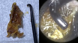 64 - Dry Hardened Plug of Ear Wax \u0026 Dead Skin Extracted using St Bart’s Ear Hook