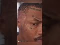 Shebeshxt showing us the scars he got from the accident