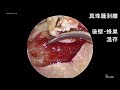 顕微鏡内視鏡併用手術：mees microscopic endoscopic ear surgery の有用性について