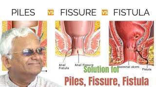 Dr Khadar Vali Solutions for Piles,  Fissure, Fistula