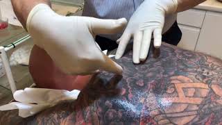 Sizeable lipoma removed by Dr. Boone duo