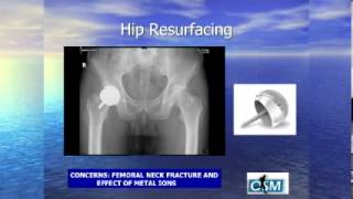 Almost Pain Free Joint Replacement,  Peter Boone MD and David Lo, MD St. Vincent's, Bpt CT