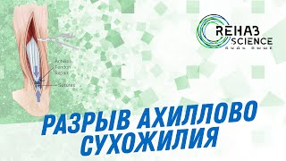 Реабилитаци после разрыва ахиллово сухожилия.