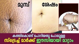 കത്തികൊണ്ട് പോറിയതു പോലുള്ള സ്ട്രെച്ച് മാർക്ക് ഈസിയായി മാറ്റാം || stretch marks home remedies