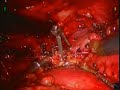 robotic resection of anterior mediastinal mass clip f. gharagozloo m.d.