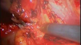 Robotic Resection of Anterior mediastinal mass clip F. Gharagozloo, M.D.