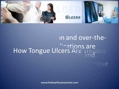 What Causes Ulcers on Tongue and How to Treat It What Causes Ulcers on Tongue and How to Treat It