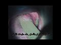 هذه ليست أورام في اللسان . أرشيف د.سامي رويهب