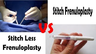 Stitchless Frenuloplasty in India | Surgery for Frenulum Breve (Tight Frenulum)