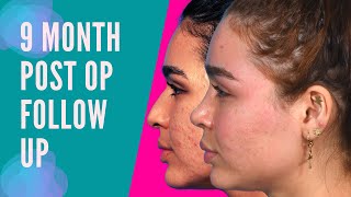 9 Month #PostOp Nosejob Magic