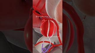 Brain Aneurysm Clipping 3d Animation