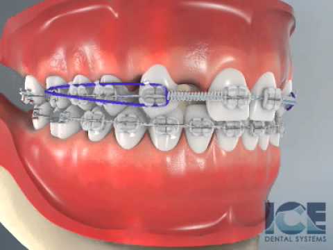 Why are my bottom teeth spacing apart with braces?