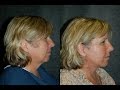 Local Anesthesia Lower Facelift on 61 Year Old Nurse | #lowerfacelift