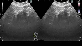 Right adrenal tumors in a dog by an echo /ultrasound (犬の右副腎腫瘍のエコー）