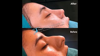 Rhinoplasty Surgery Before and After Transformation