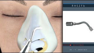 Piezotome M+ for Ultrasonic Rhinoplasties