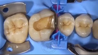 Class 2 Composite Restoration Using bulk fill Flowable composite - sectional matrices and wedge